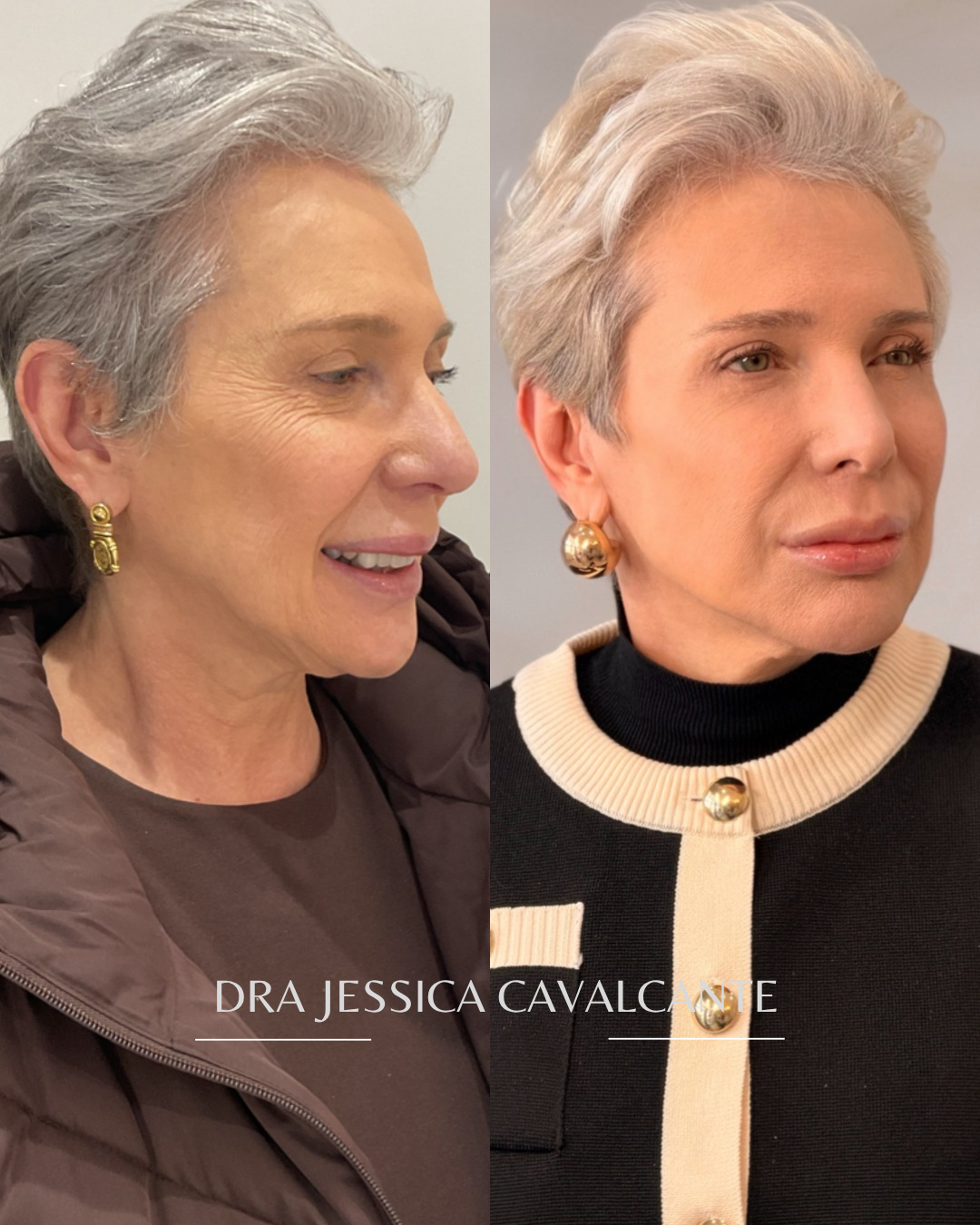 Antes e depois — resultado real 01