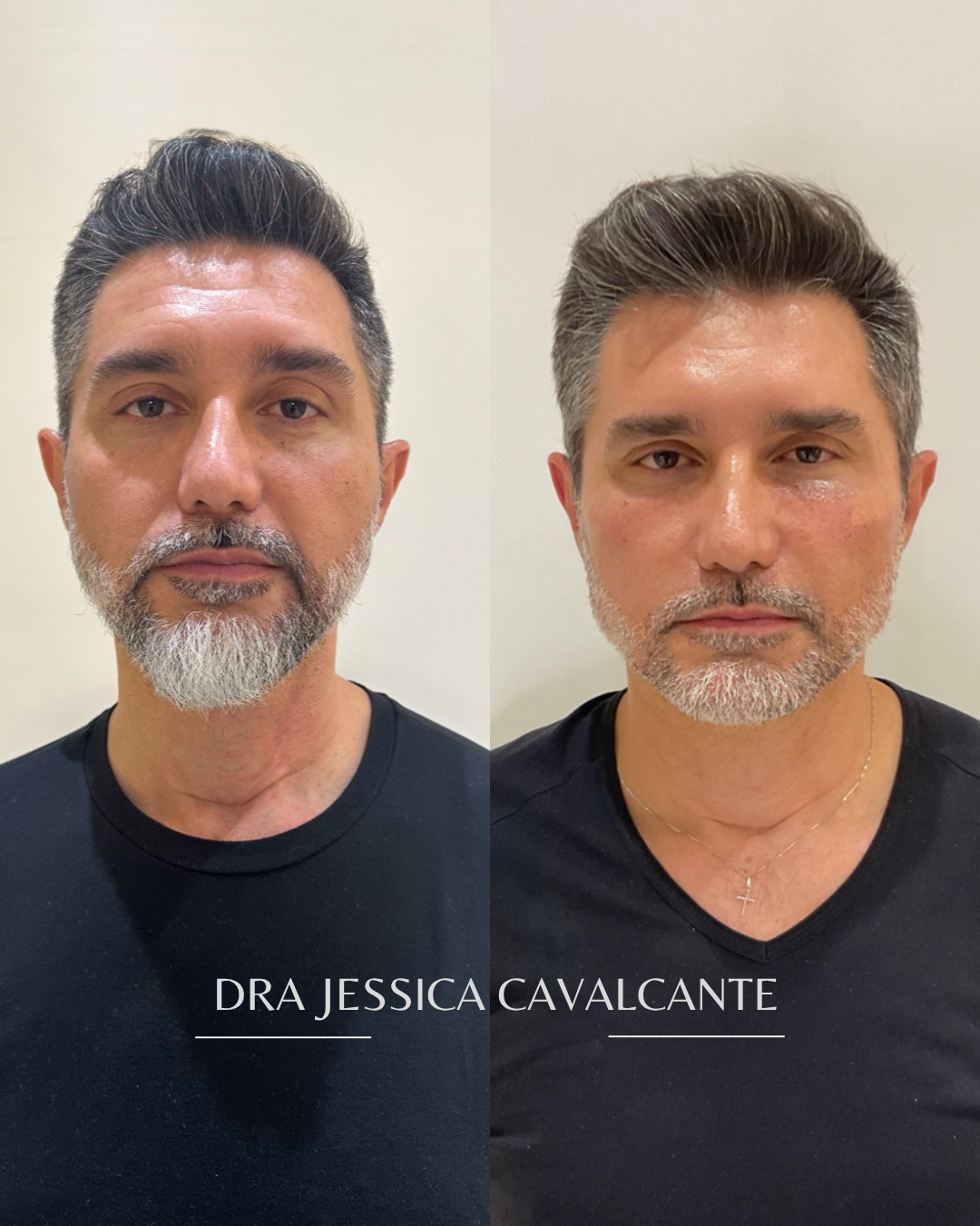 Antes e depois — resultado real 03