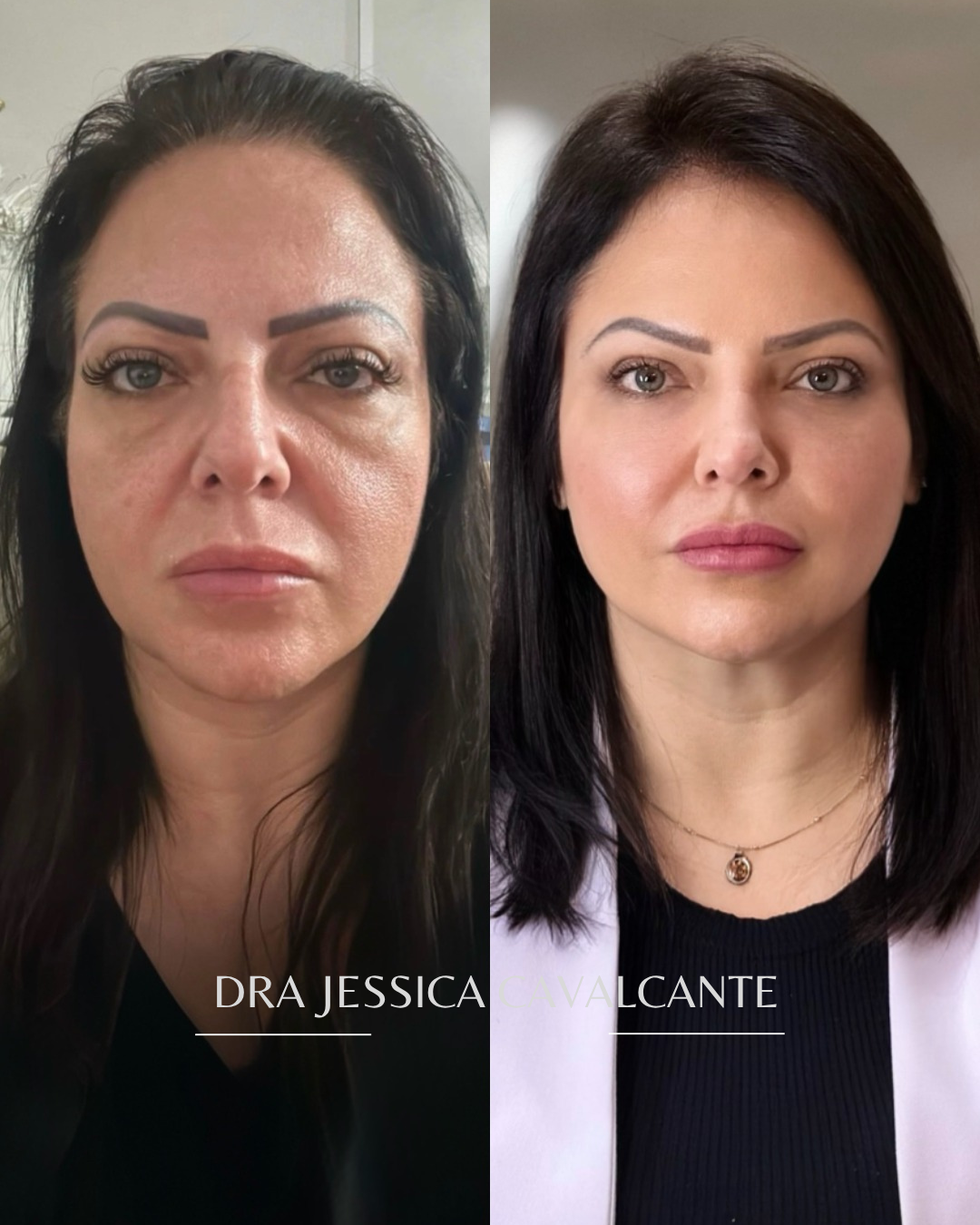 Resultado real da Allure Clinic