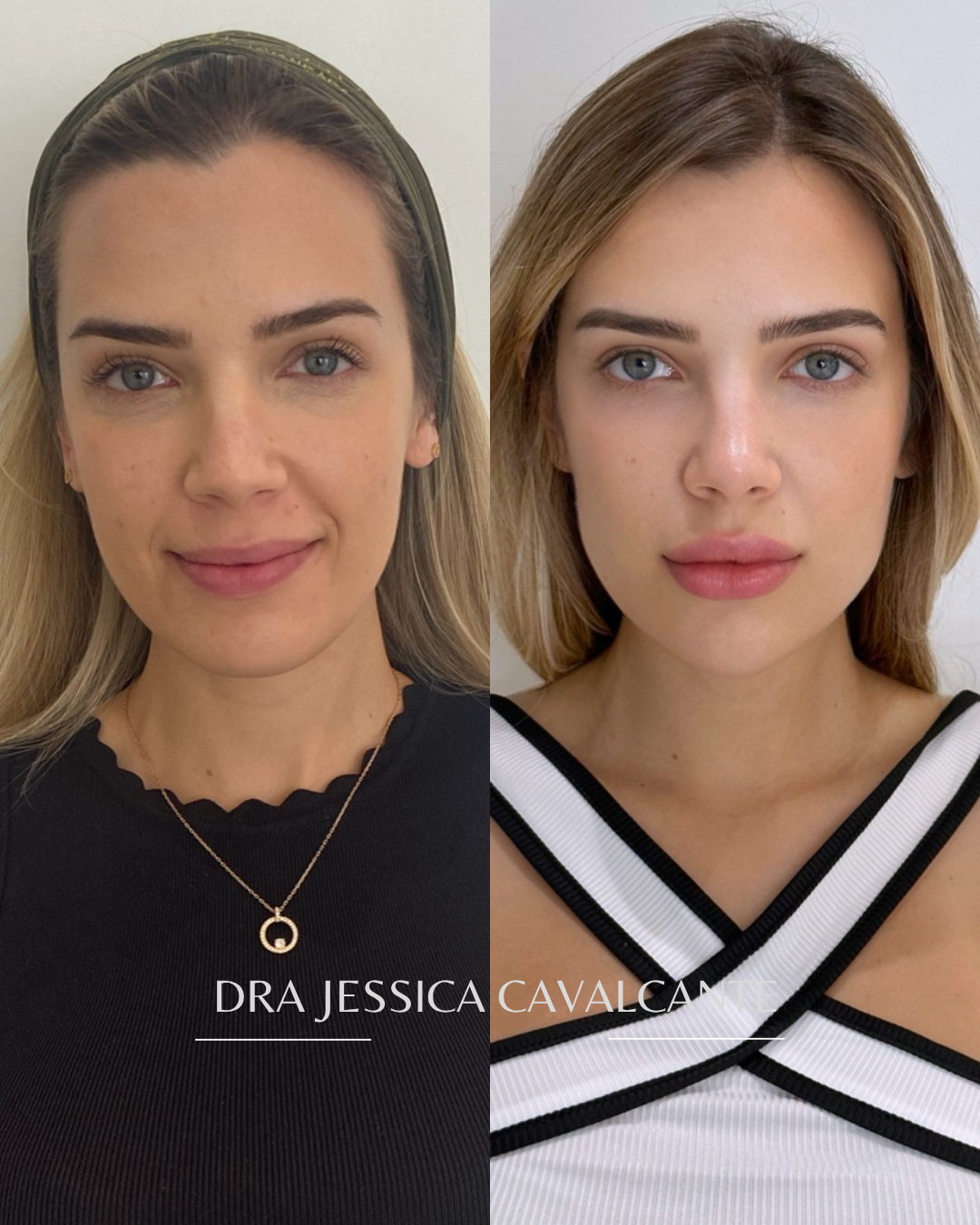 Resultado real da Allure Clinic