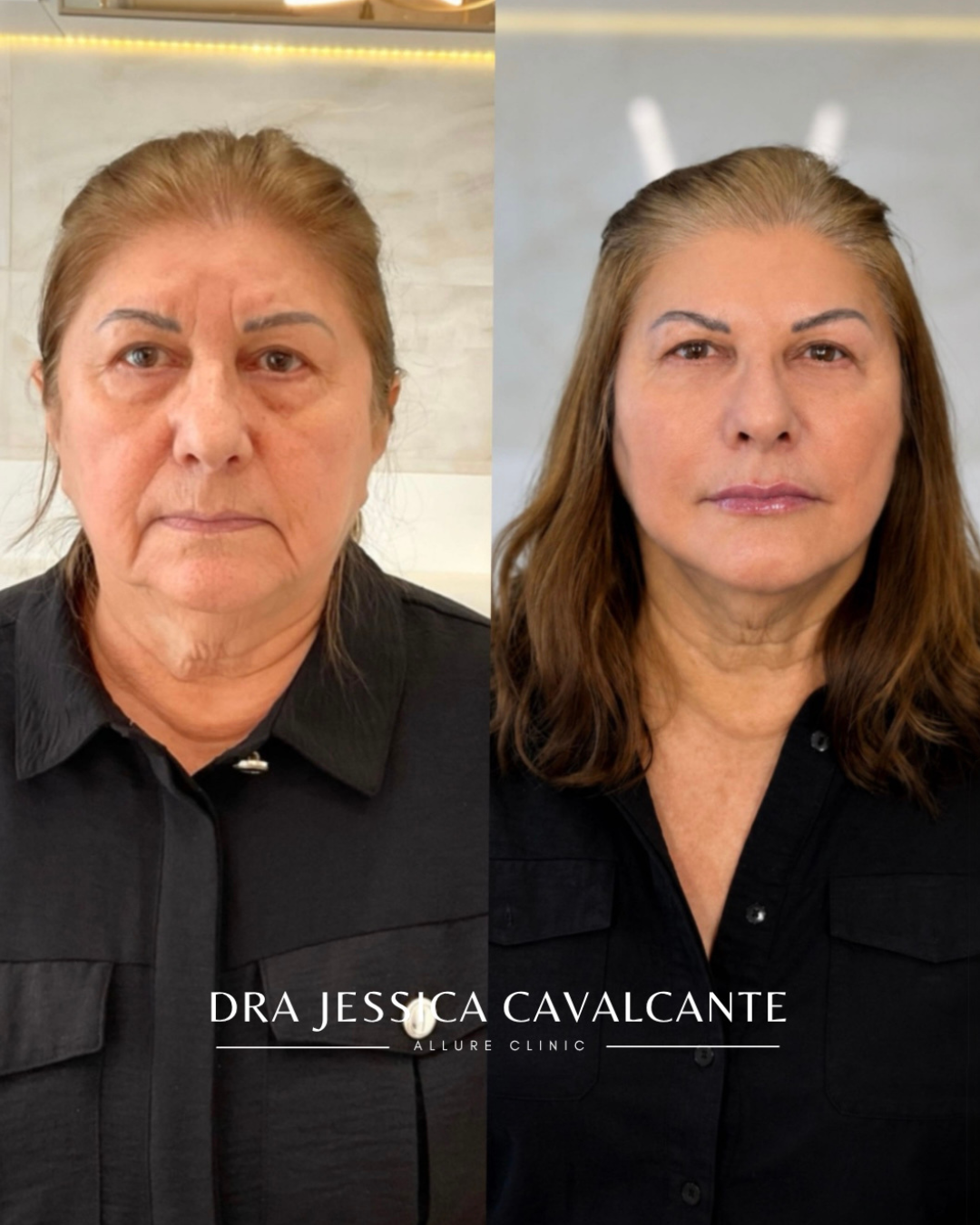 Resultado real da Allure Clinic